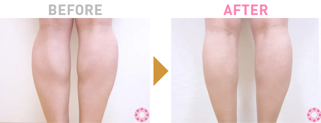 Before After 1