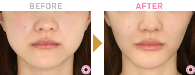 Before After 1