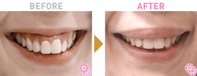 Before After 2