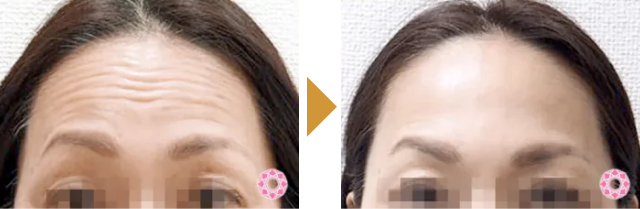 Before After 3